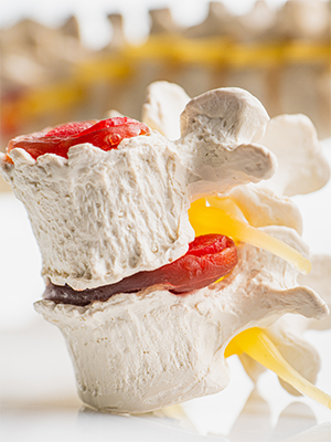 How to Fix a Herniated Disc Without Surgery How to Fix a Herniated Disc Without Surgery